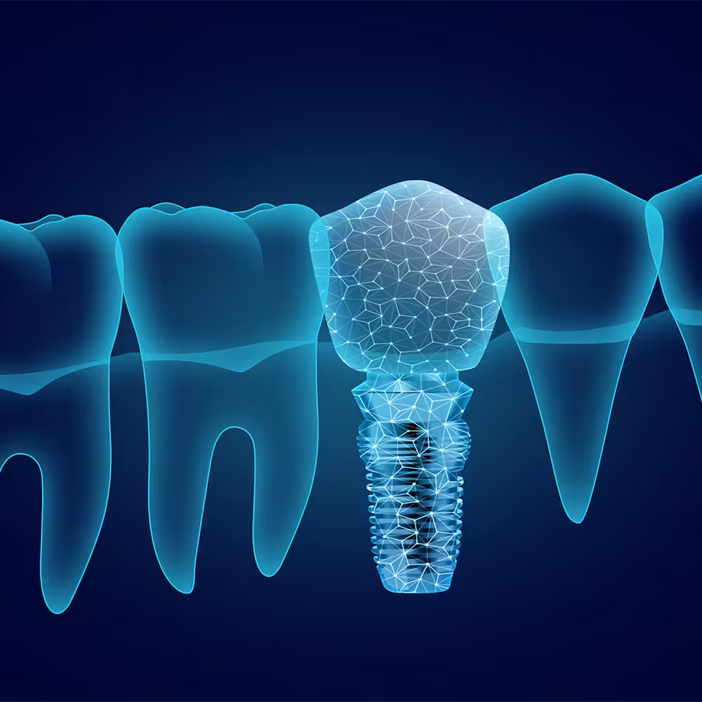 Dental implant