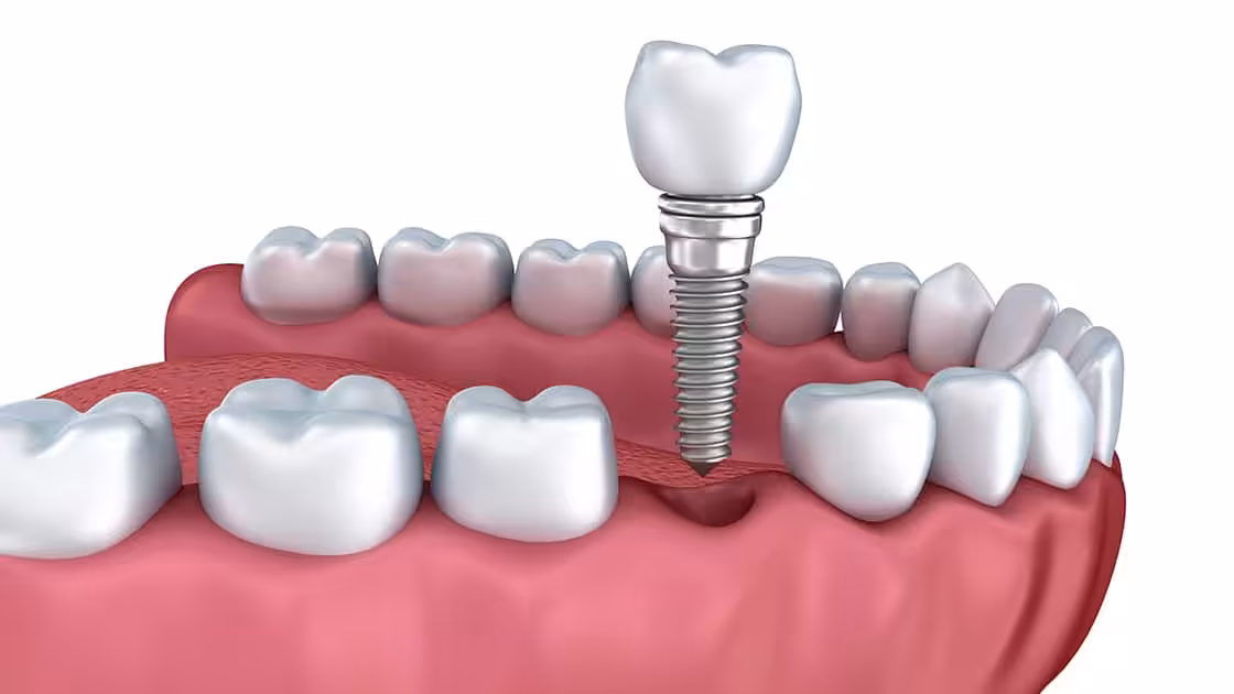 Dental Implant Restoration