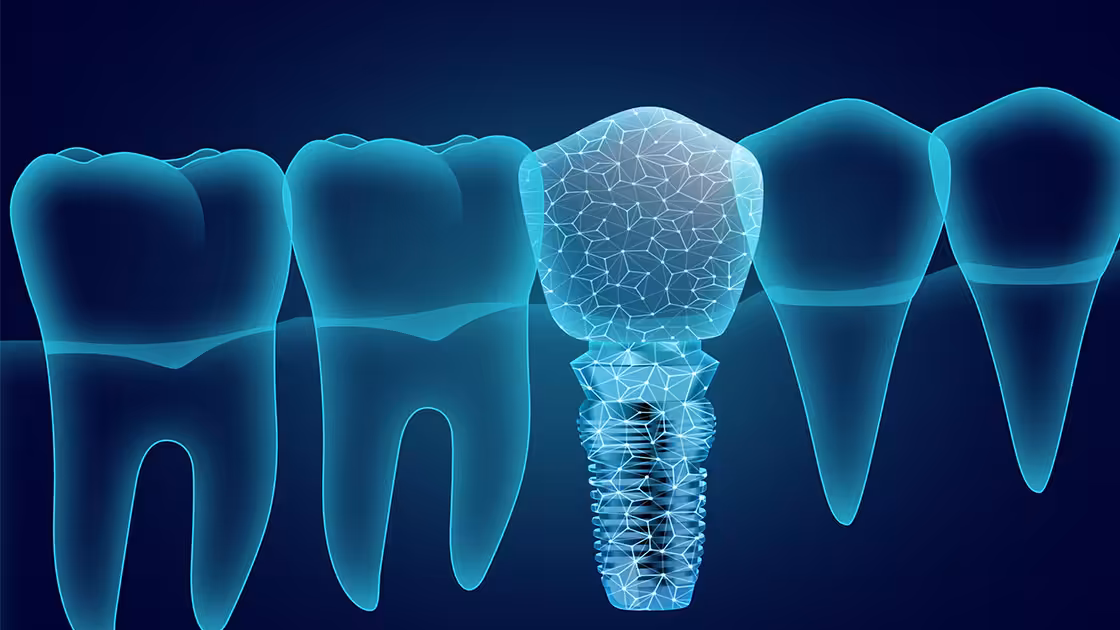 Dental implant