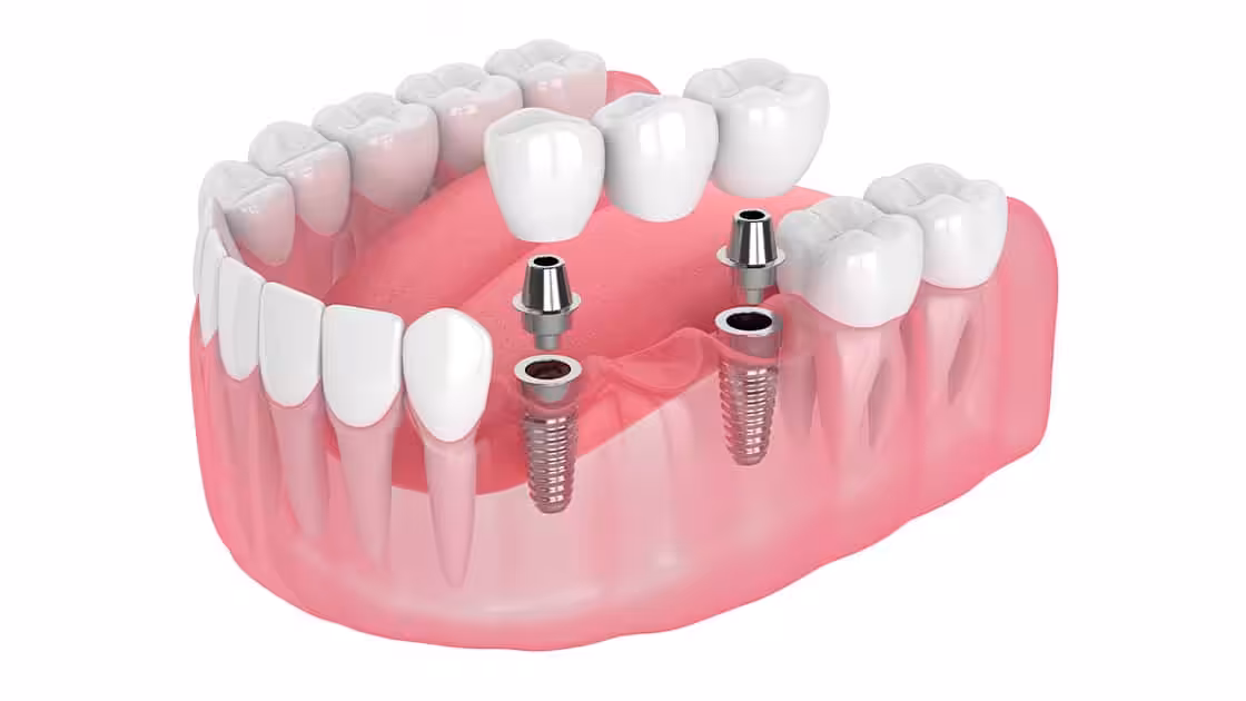 Dental Supported Bridges Image