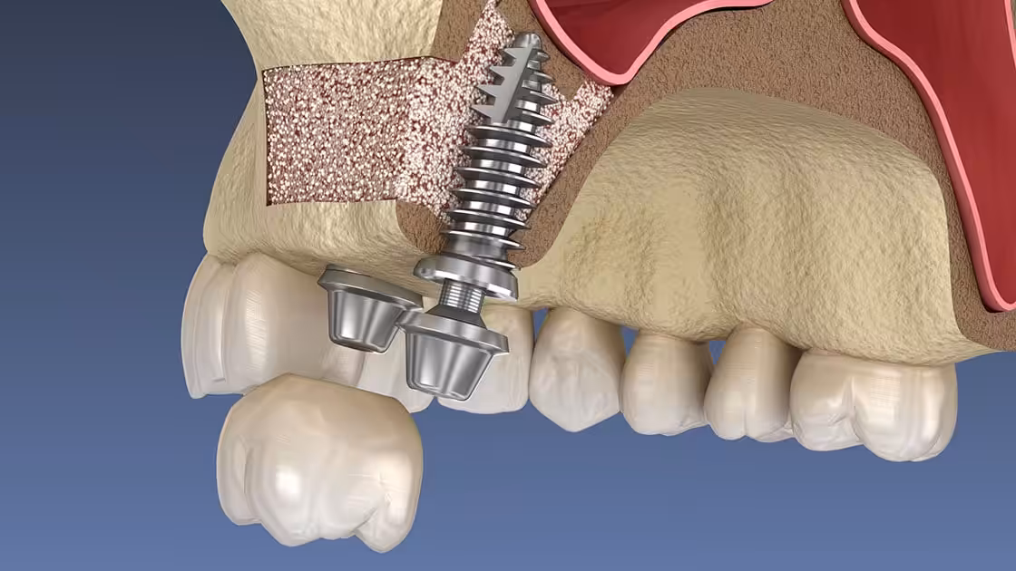 Sinus Lift