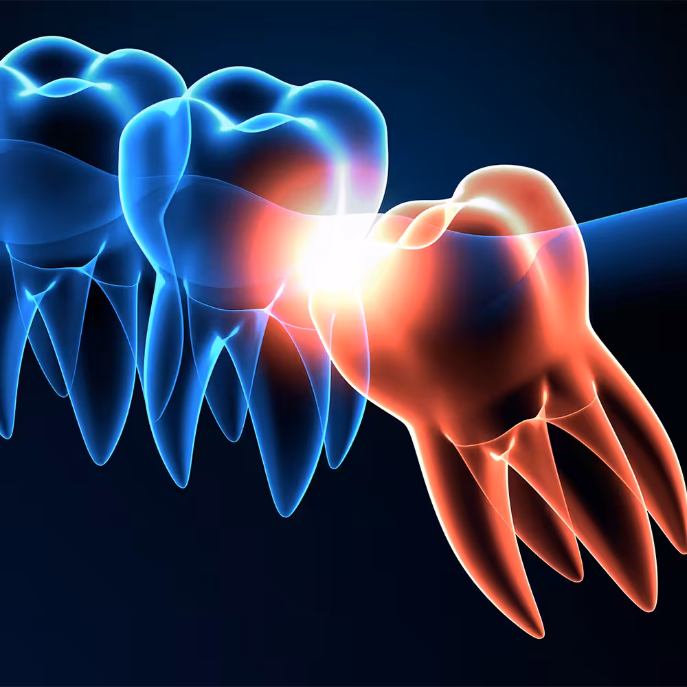 Wisdom teeth