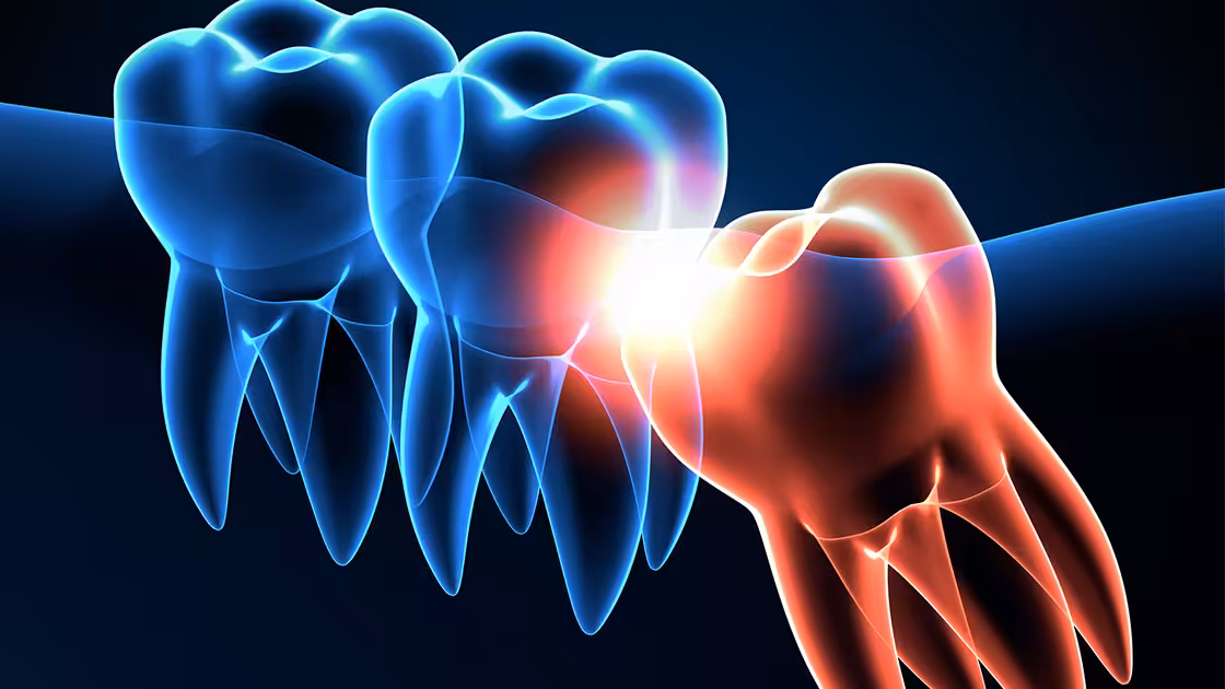 Wisdom teeth
